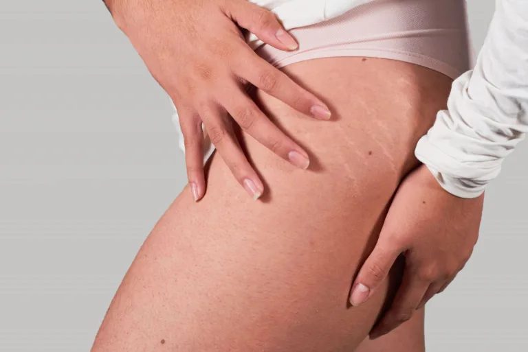 Comment camoufler naturellement les vergetures sans chirurgie ?