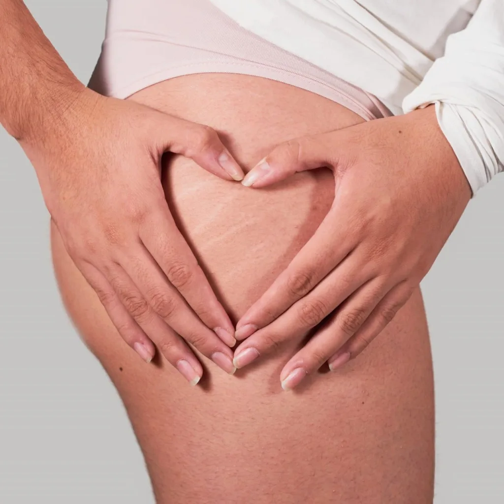 Camoufler ses vergetures avec la dermopigmentation