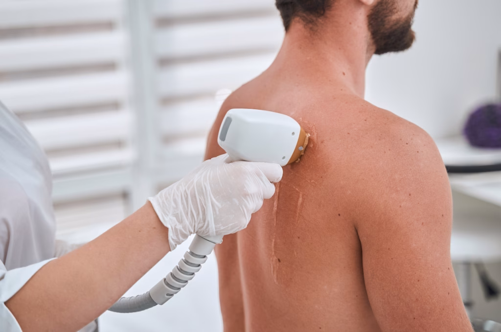 Épilation lumière pulsée pour homme